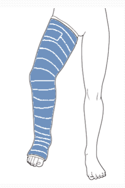 Term Leg Cast Different Types of Fracture Casting | Guide to Orthopedic Casts for Limbs