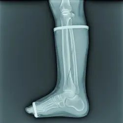 نمای رادیولوژی از اندام گچ‌گیری‌شده با باند فایبرگلاس که جزئیات استخوان را با شفافیت بالا نشان می‌دهد