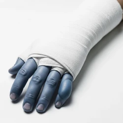 دست گچ‌گرفته با انگشتان متورم و متمایل به کبودی به‌عنوان نشانه عصبی-عروقی خطرناک پس از گچ‌گیری